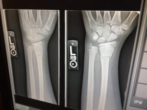x-ray results