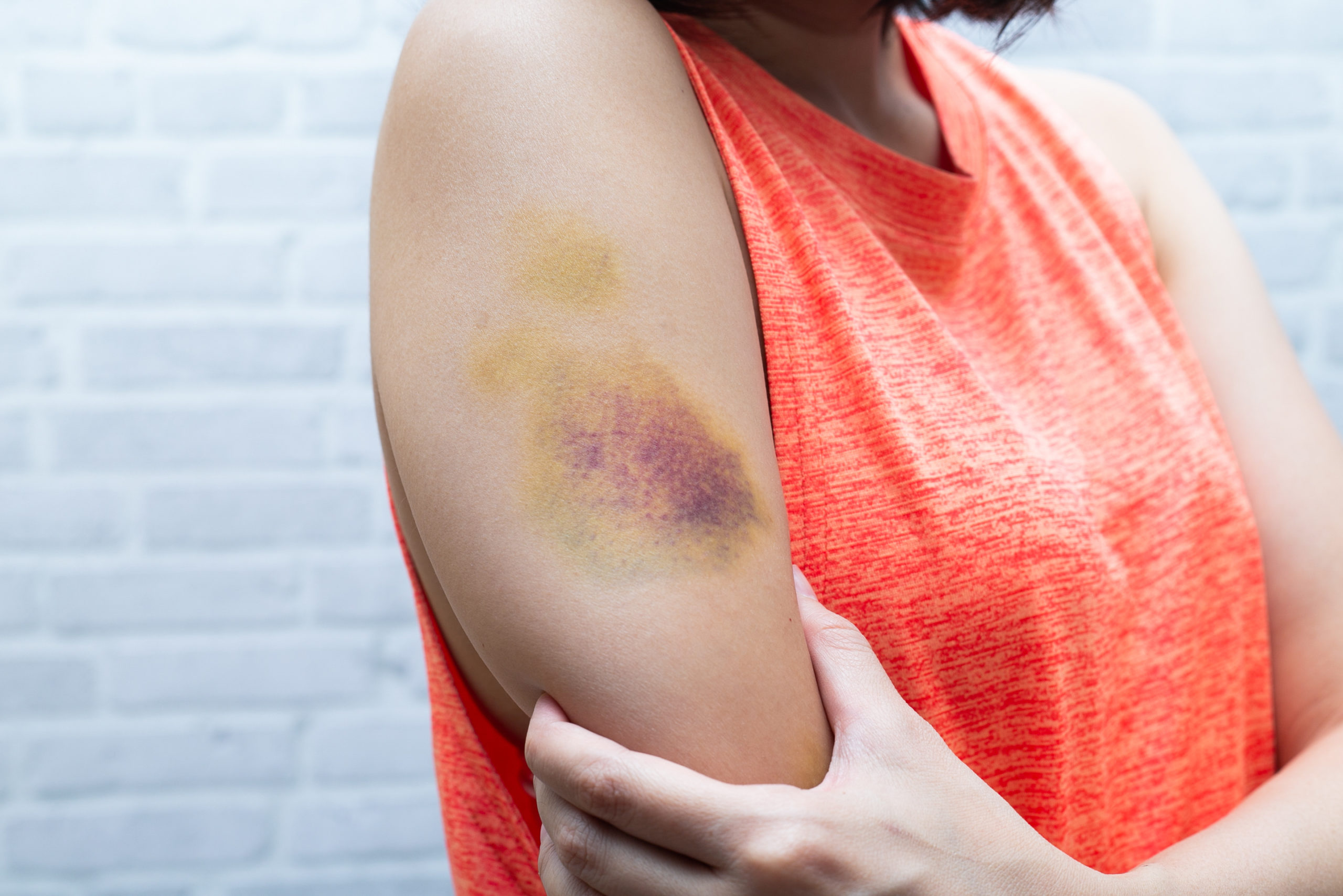 How Do You Know When A Bruise Is Serious State Urgent Care