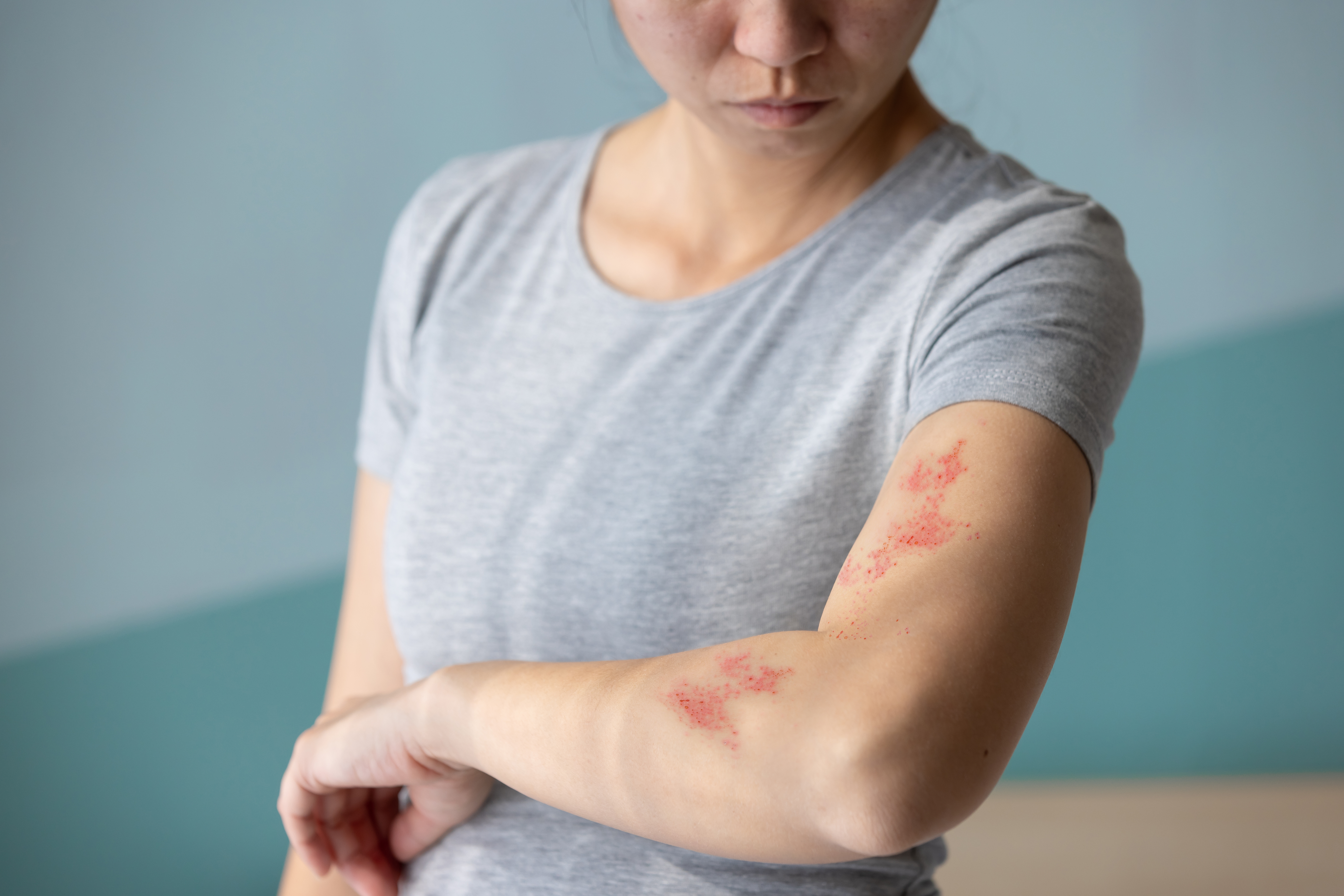 Woman examining a painful red rash on her upper arm
