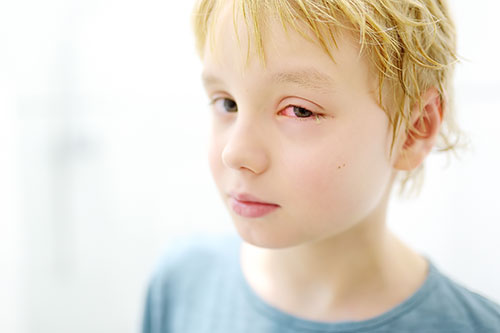 Boy with red eye infection