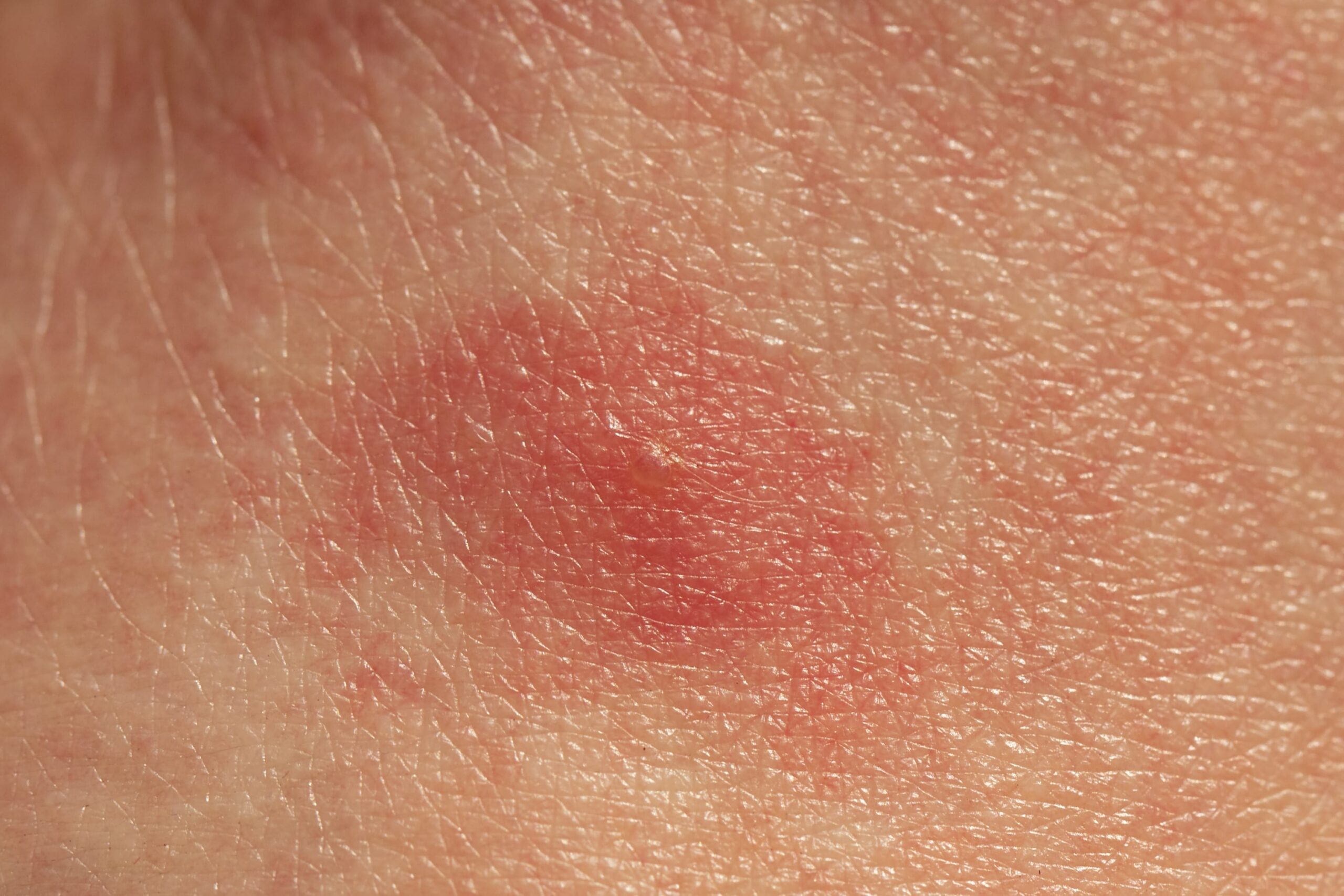 Close-up of red, inflamed skin showing a small raised bump from an insect bite on human skin.